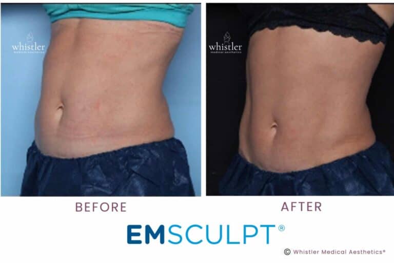 ANGELA-SIDE-VIEW-EMSCULPT-e1663704333639-768x512