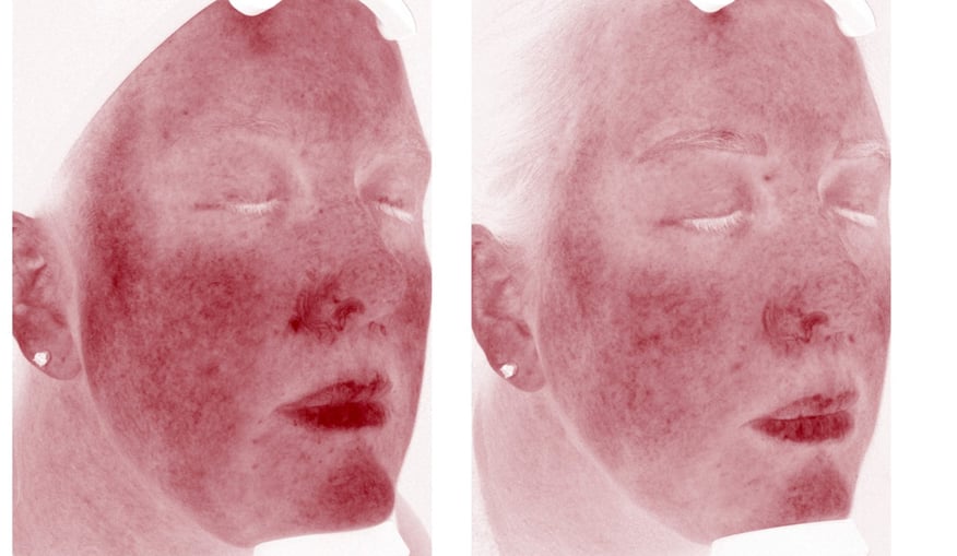 ClearSilk Before and After - 3 Whistler-1