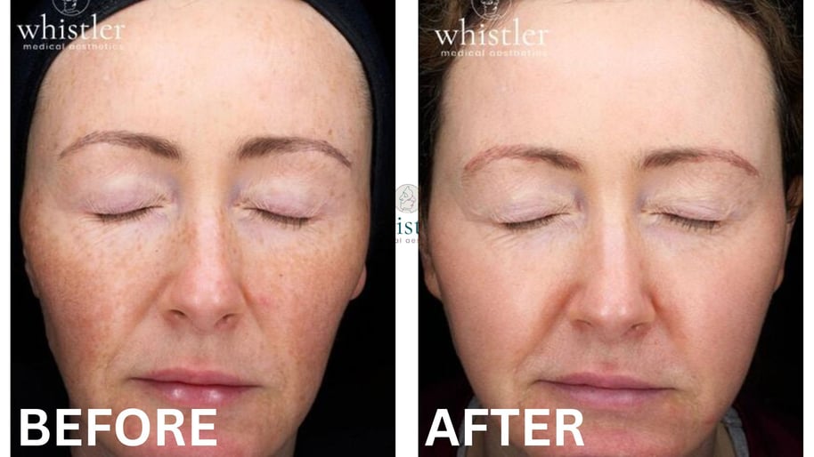 Halo Laser Before and After Whistler