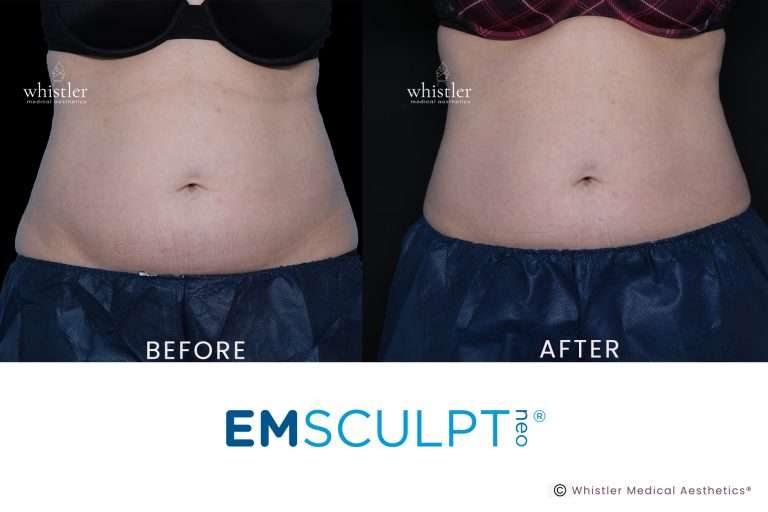 NEo-Female-before-after-Jan-2022-2jpg-768x512
