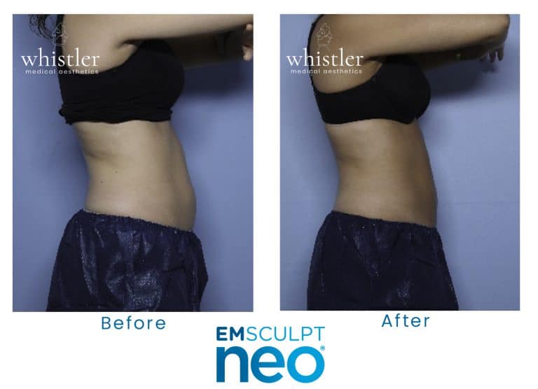 Neo-before-after-1-768x556