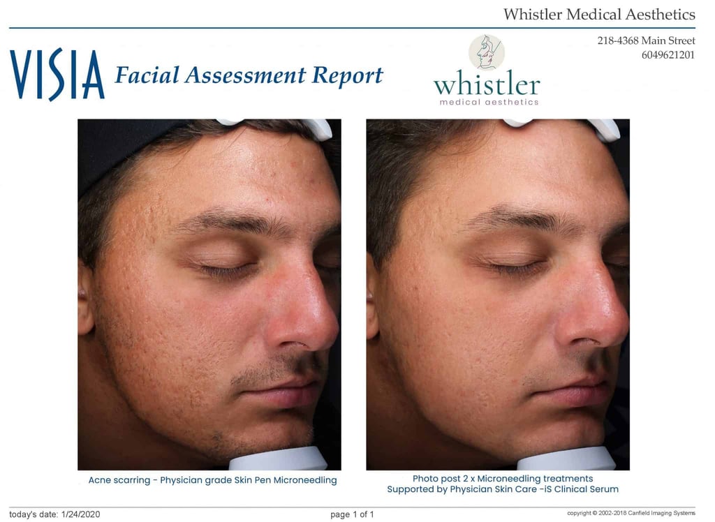 Skinpen Before & After