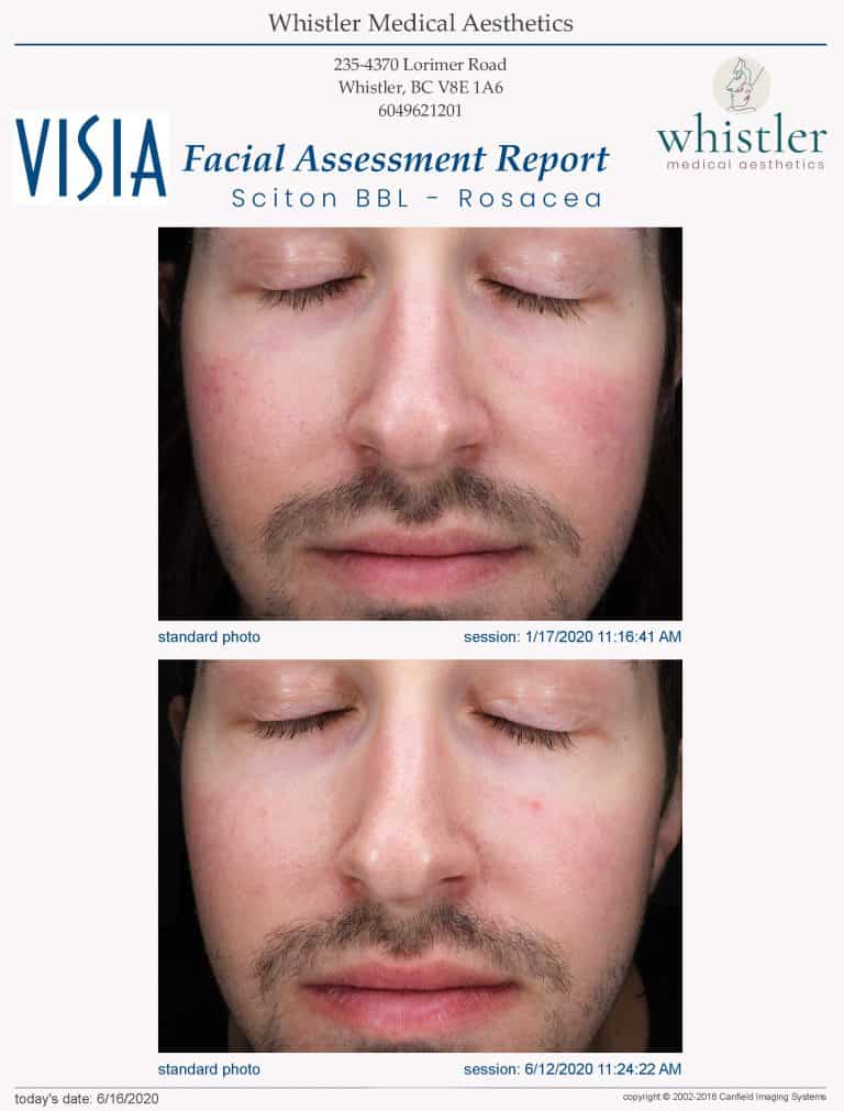 Before and After BBL for Rosacea