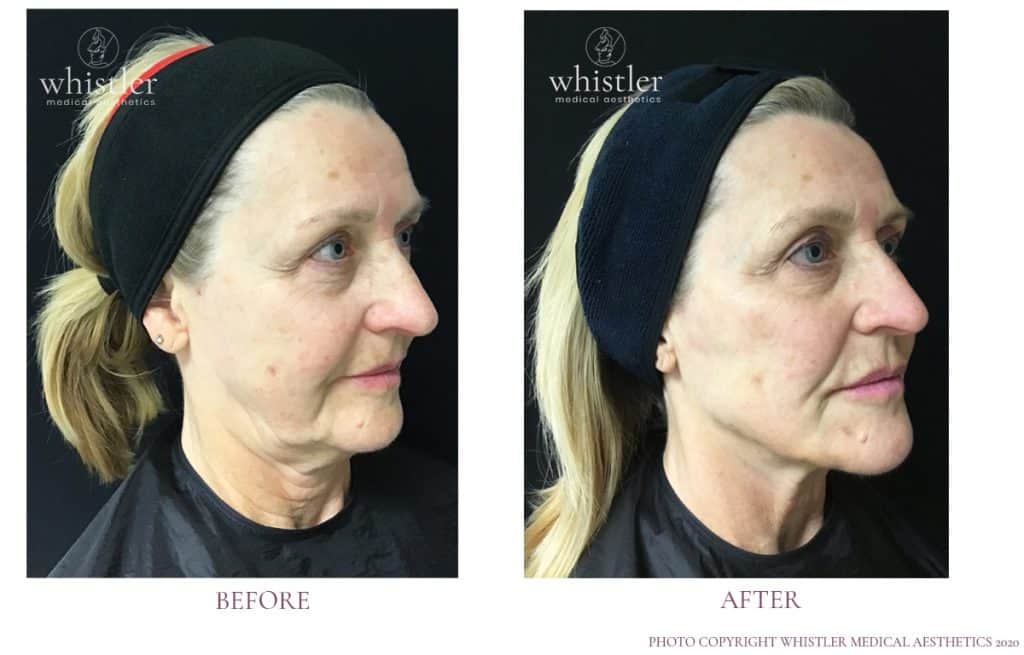 Bev Before after Bev Before after
