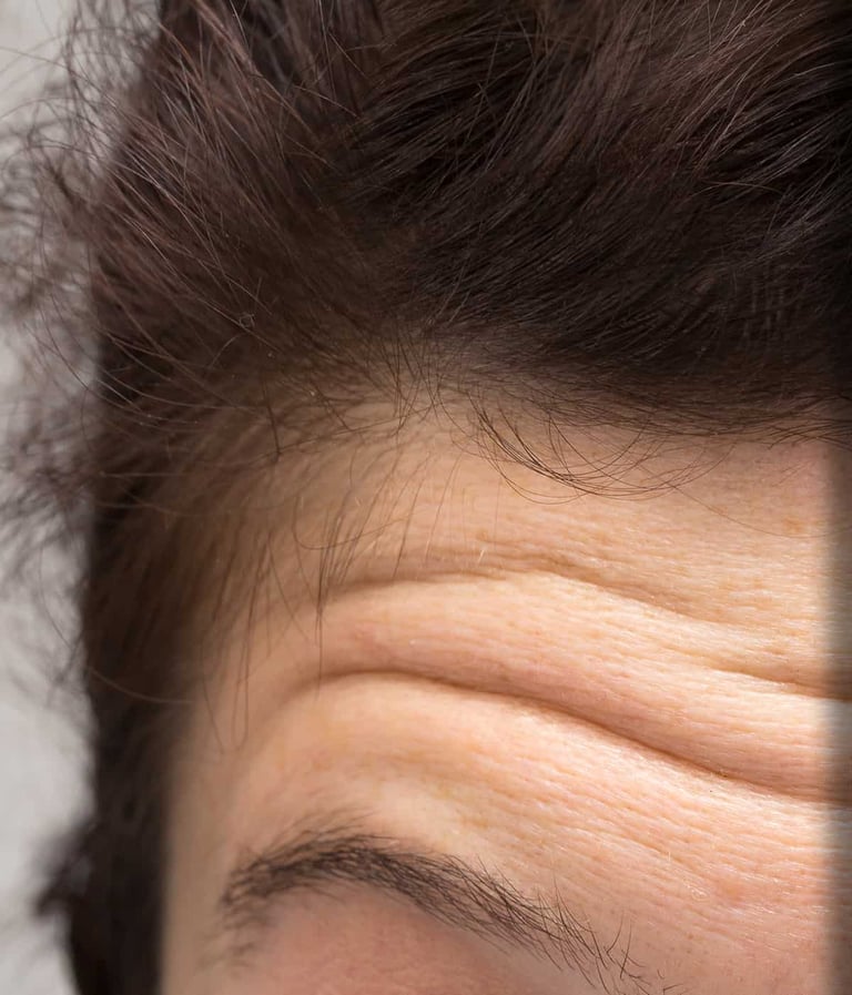 Static lines before treatment with botox