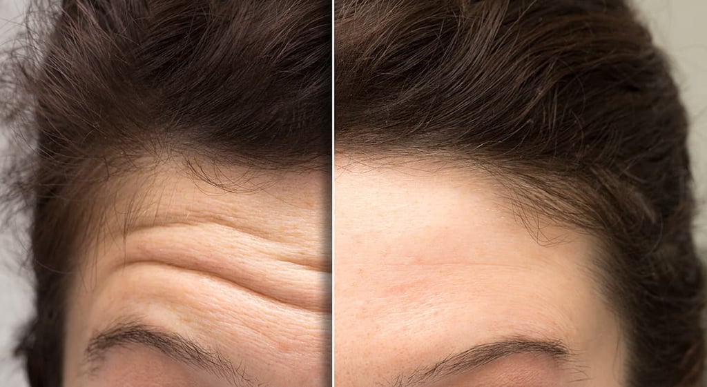 Botox-forehead