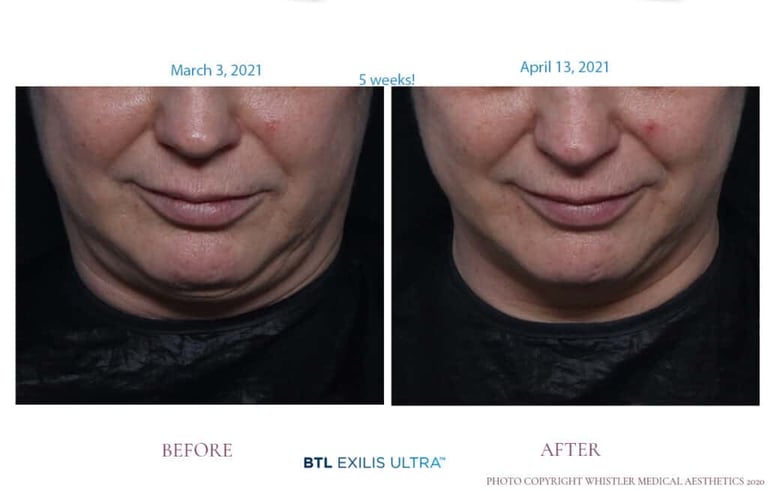 Exilis-Full-Face-and-Chin-1024x655