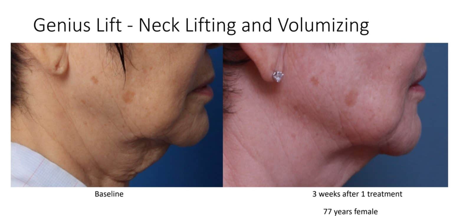 no surgical Skin tightening with micro needling