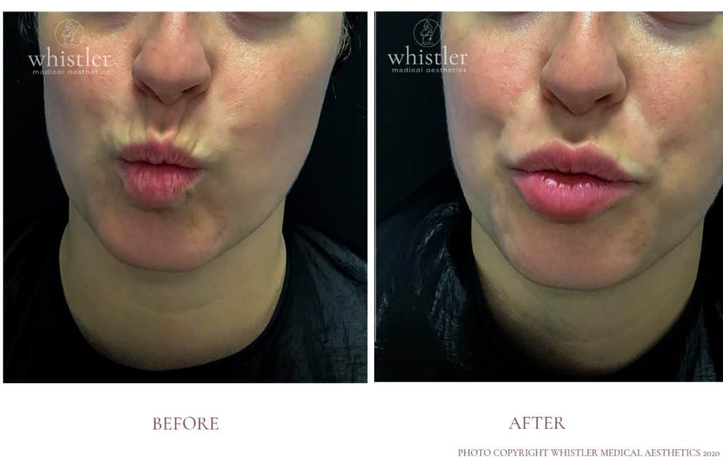 LIP LINES 2 LIP LINES 2