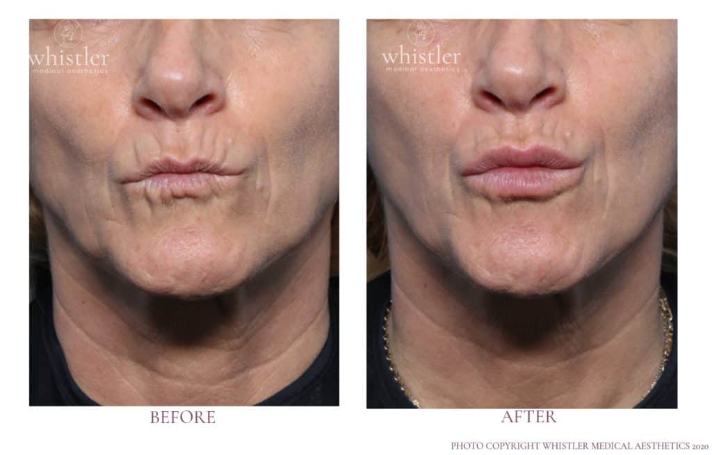 Lip lines Volite and Dermal Fillers Lip lines Volite and Dermal Fillers