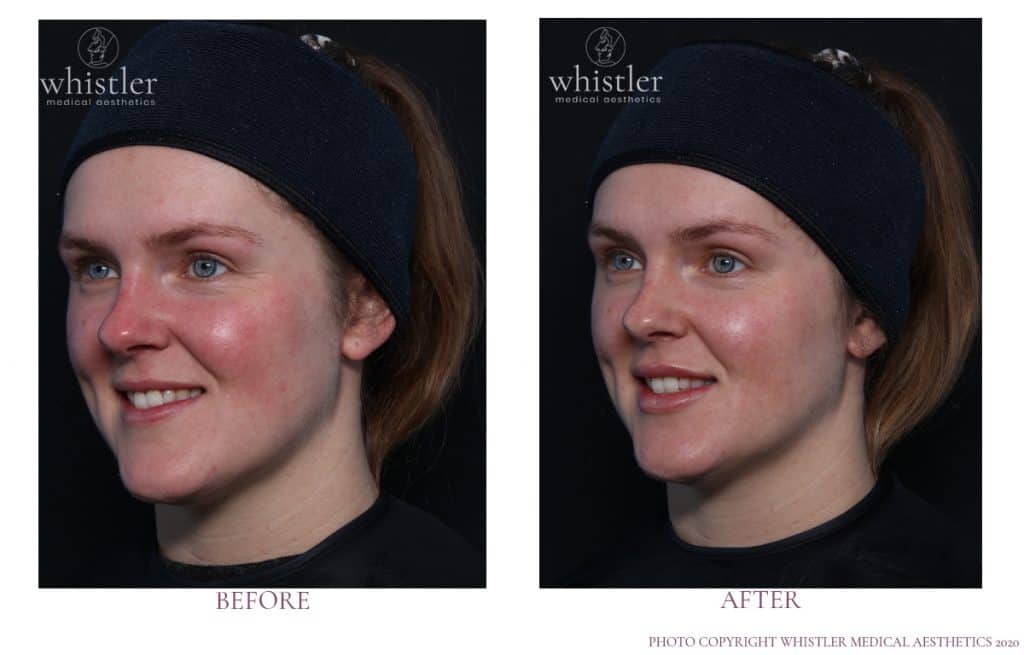 Karen full face Karen full face