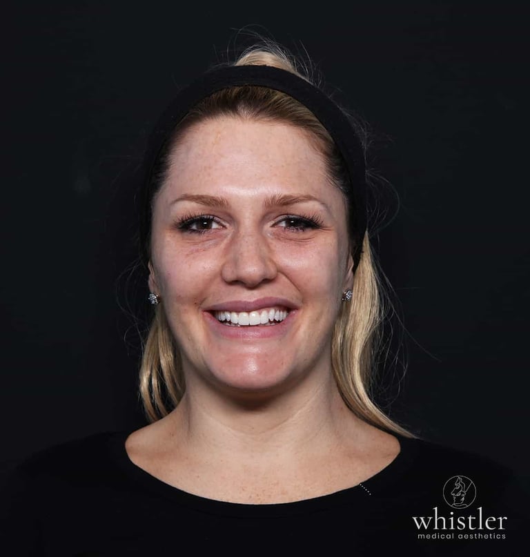 Linsey half face correction