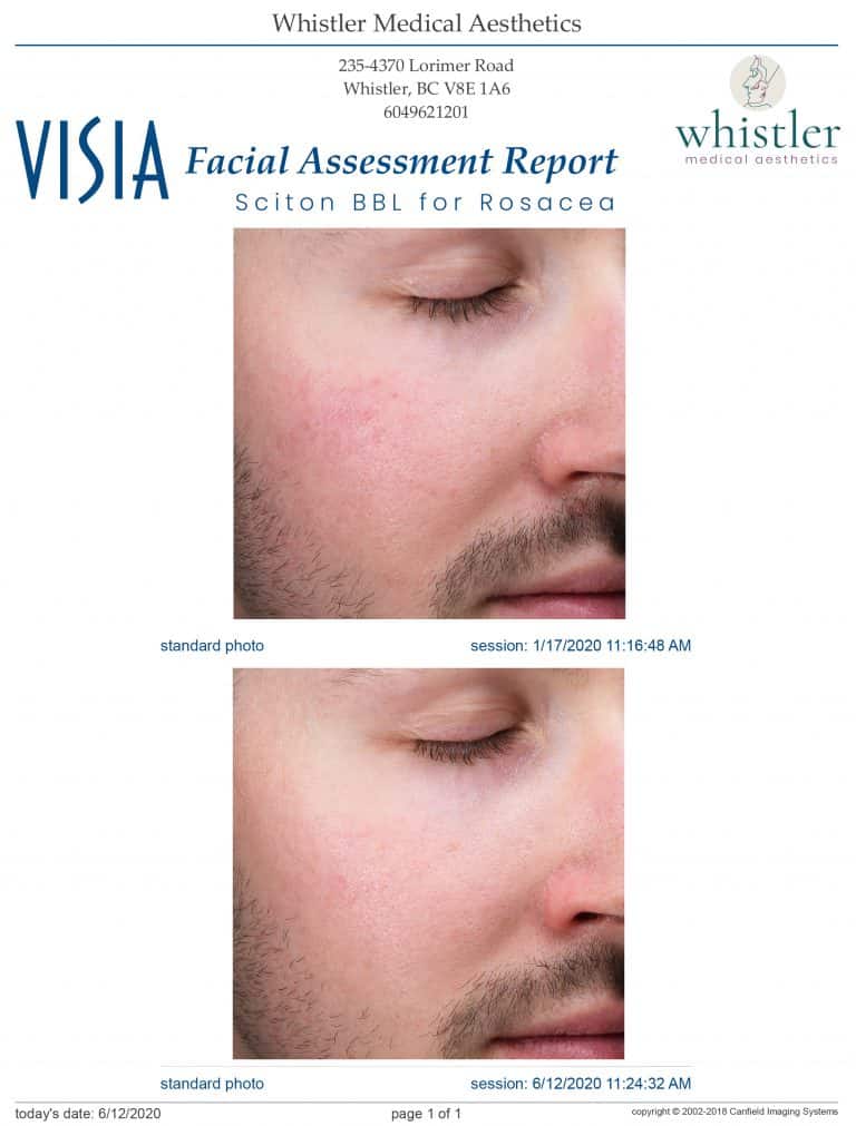 Male Rosacea BBL side Male Rosacea BBL side