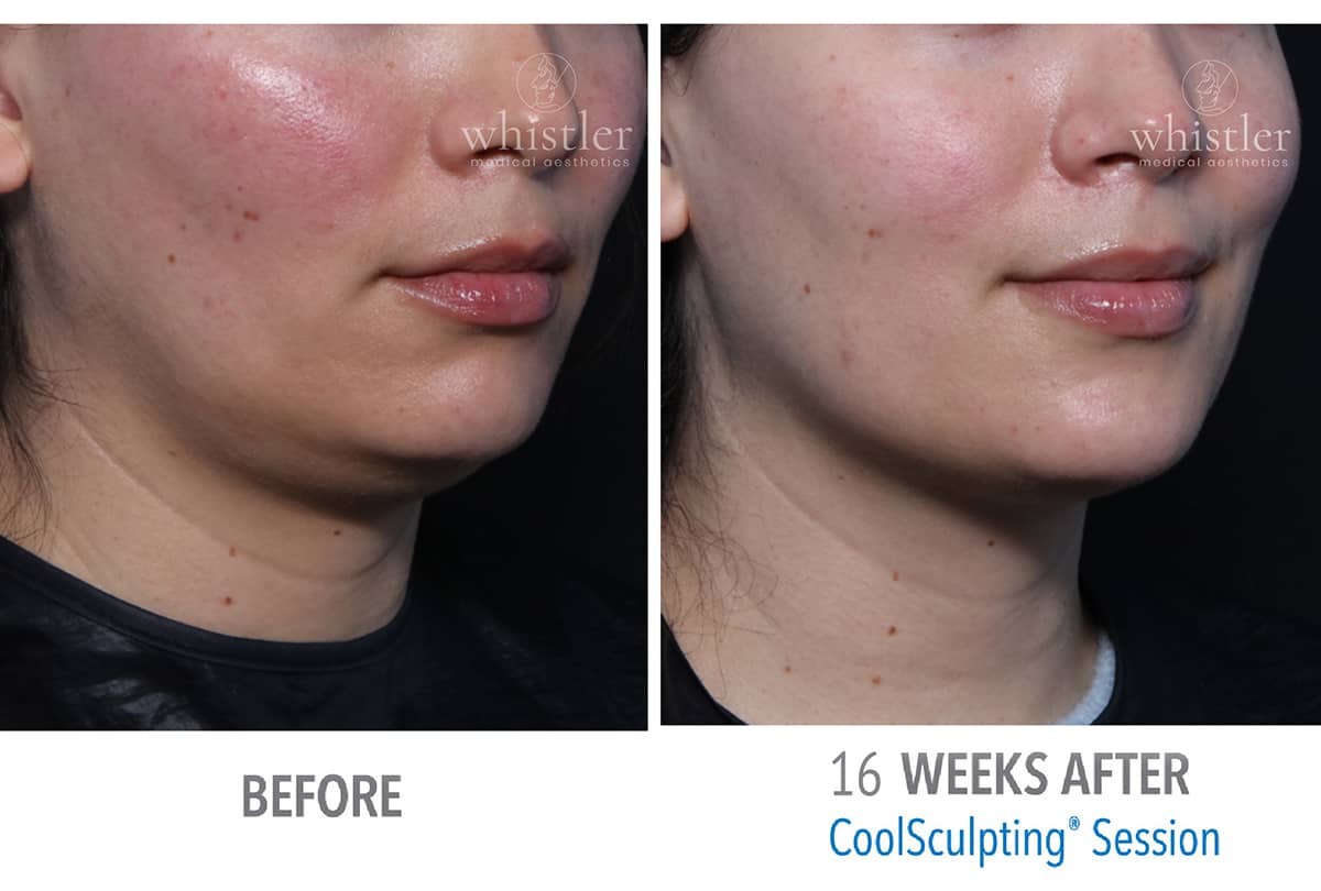 CoolSculpting Under Chin Amazing Results