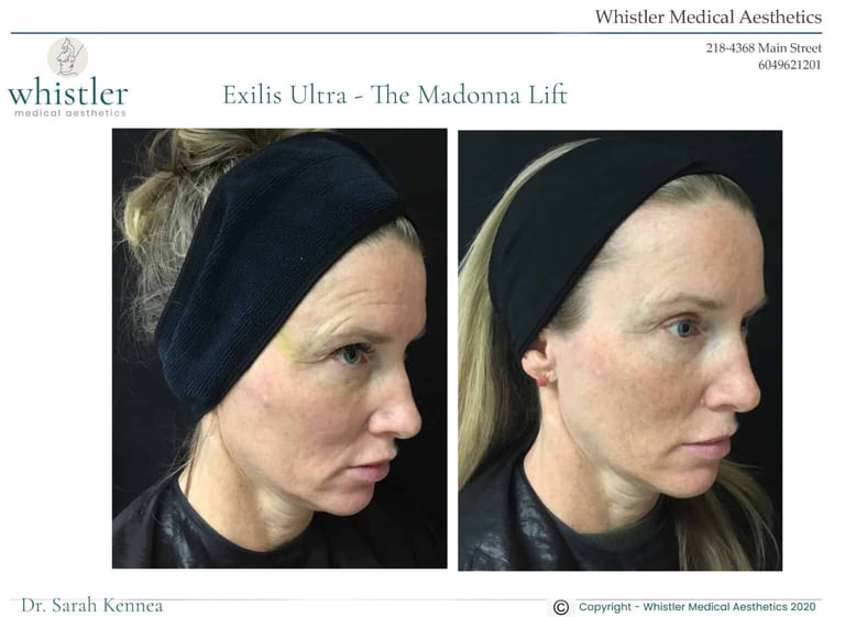 Sandra-before-after-exilis-2-2-1536x1123