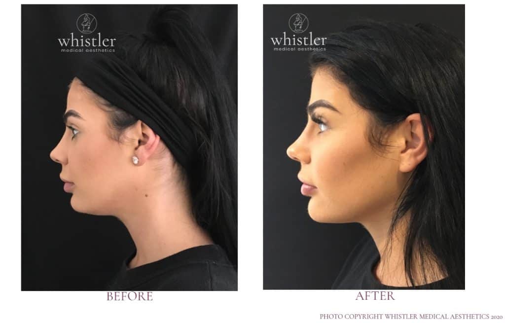 Volux treatment