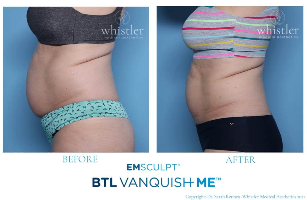 before after Vanquish Me Emsculpt