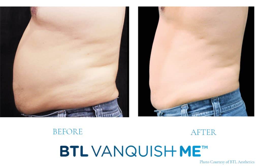 before after male vanquish