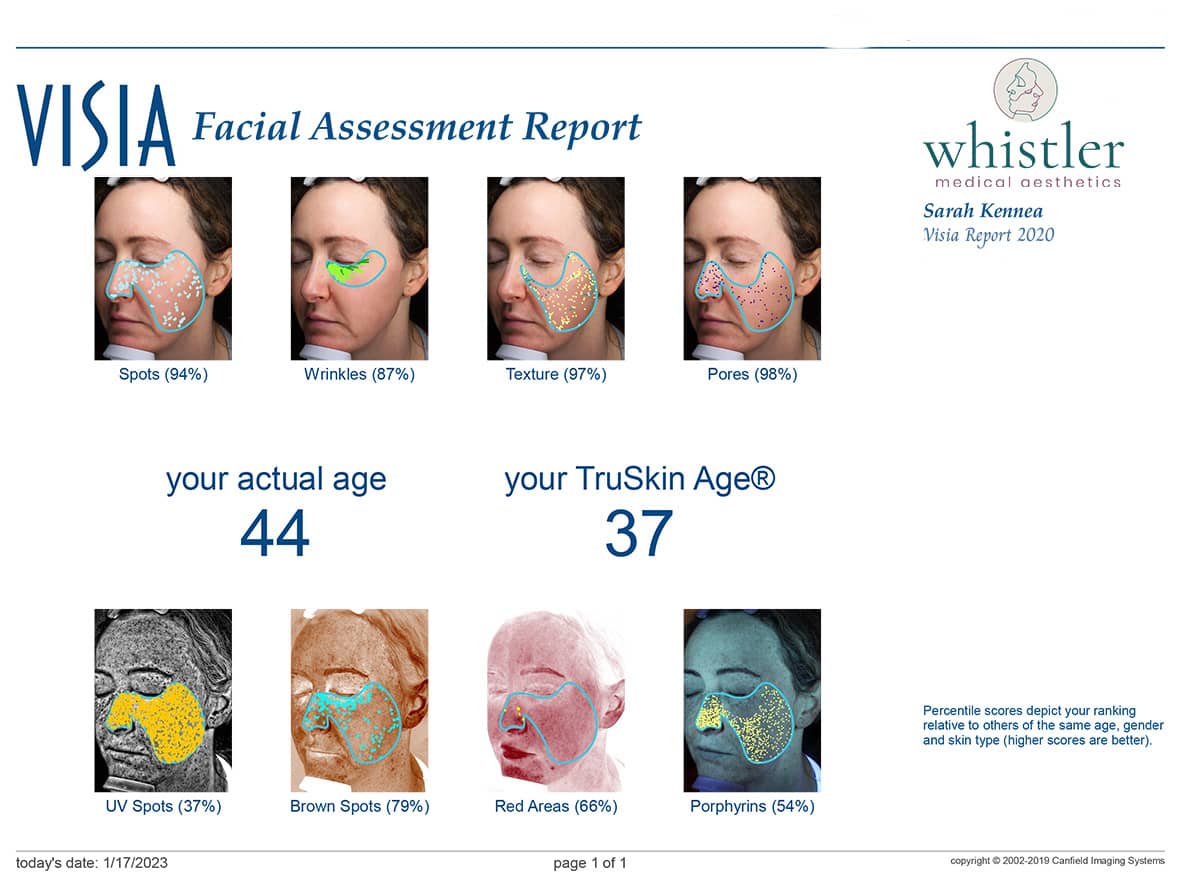 Tru Skin Age Report Visia