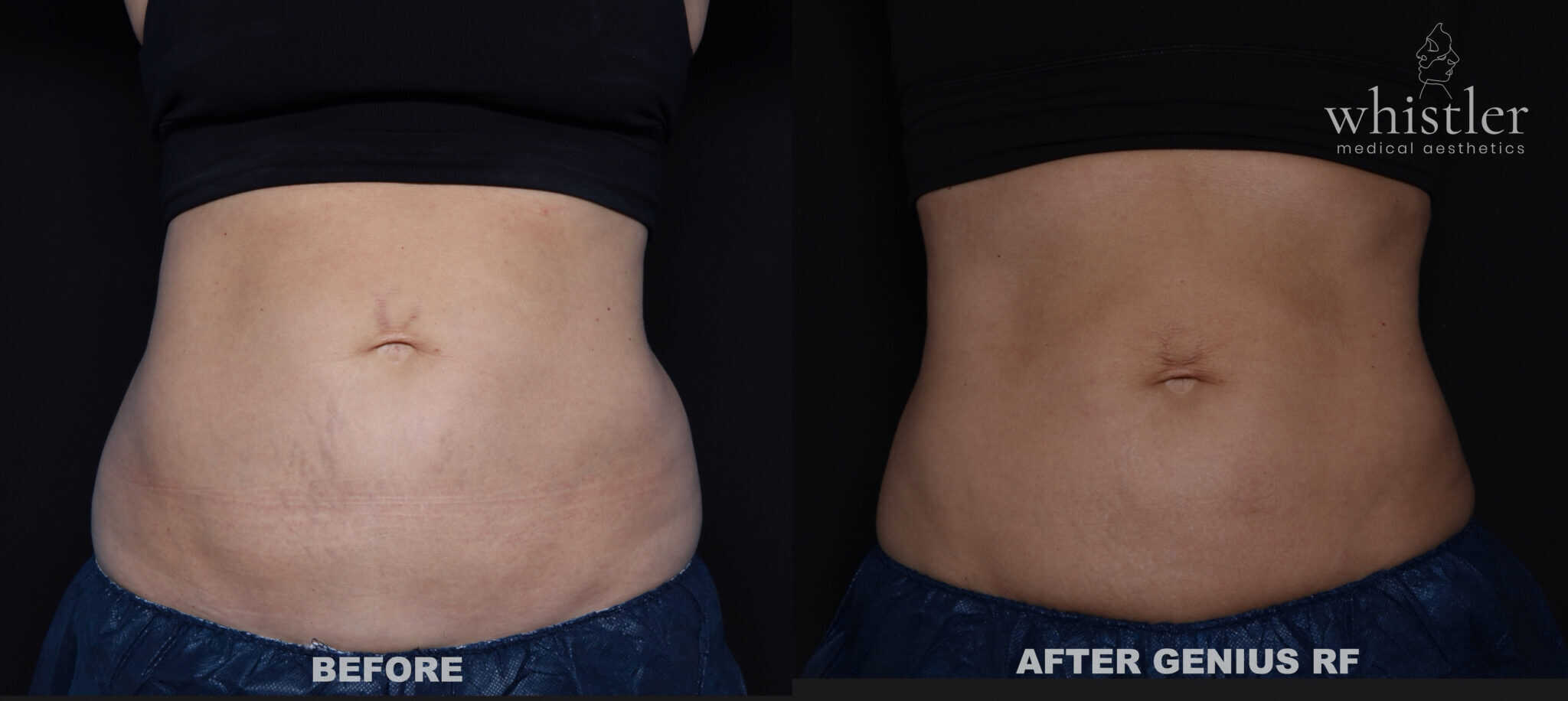 Rf Microneedling stomach before and after stomach