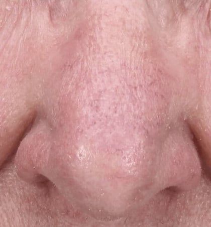 Z-Wave Pro Treatment After