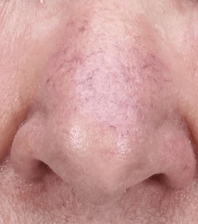 Z-Wave Pro Treatment Before