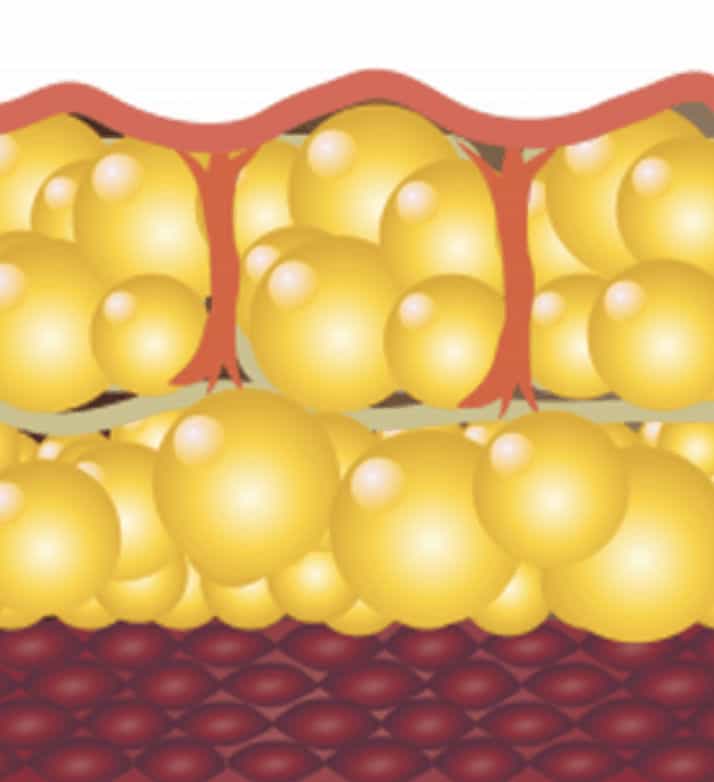 Cellulite Before ZWave Treatment