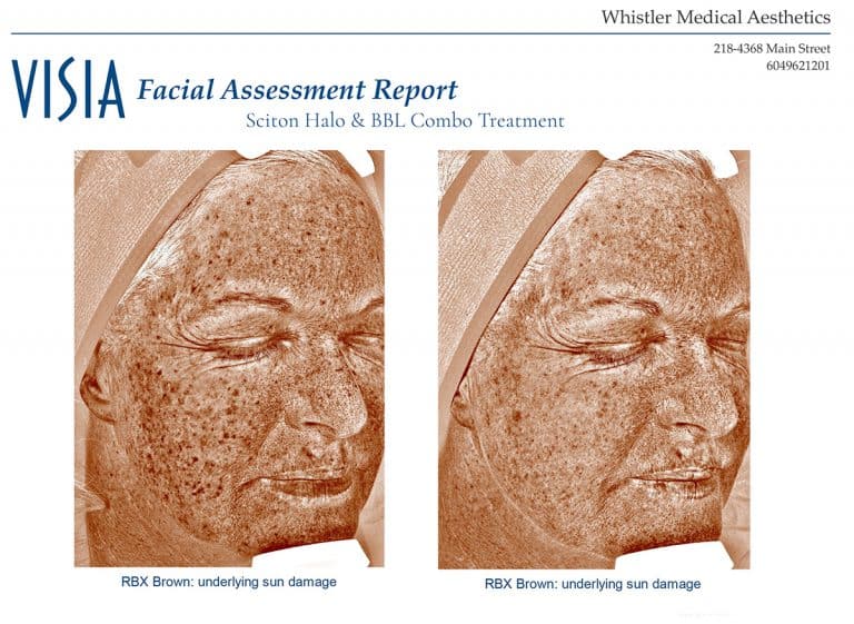 visia facial analysis sun damage Whistler