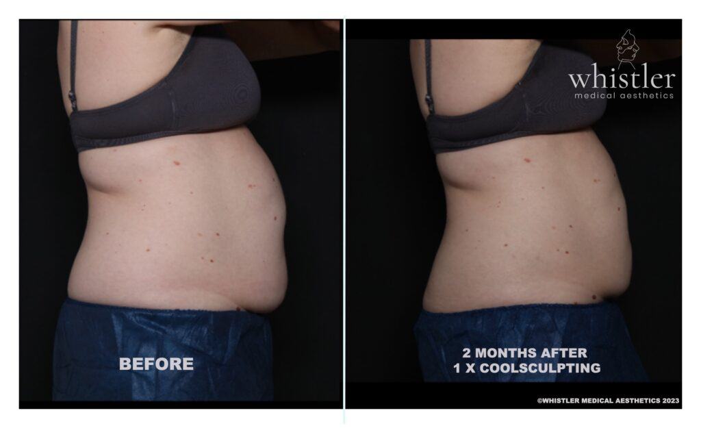 1-ROUND-COOLSCULPTING-BEFORE-AFTER-2023-1024x625
