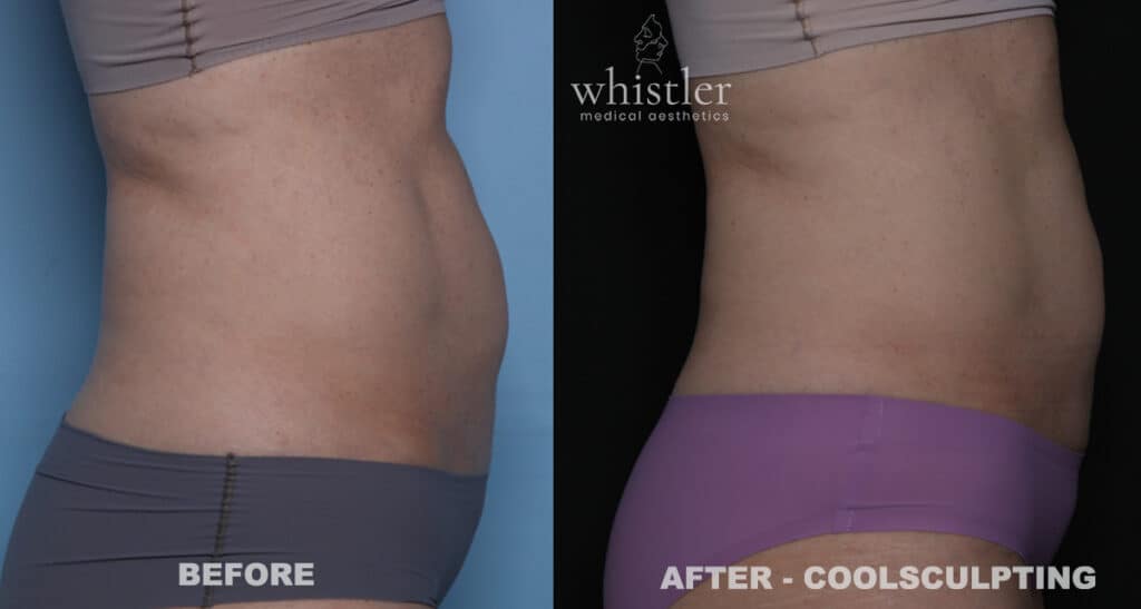 BEFORE-AFTER-SIDE-COOLSCULPTING-SEPT-2023-1024x547