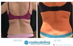 Bra-strap-and-flanks-coolsculpting-300x192