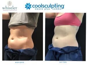 COOLSCULPT-BEFORE-AFTER-300x225