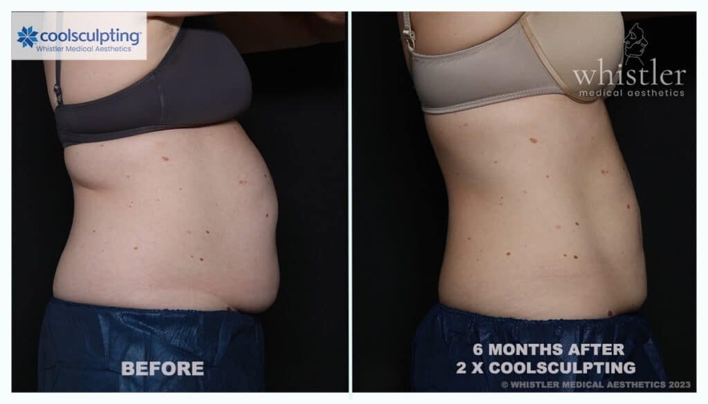 COOLSCULPTING-BEFORE-AFTER-SIGNIFICANT-1024x585