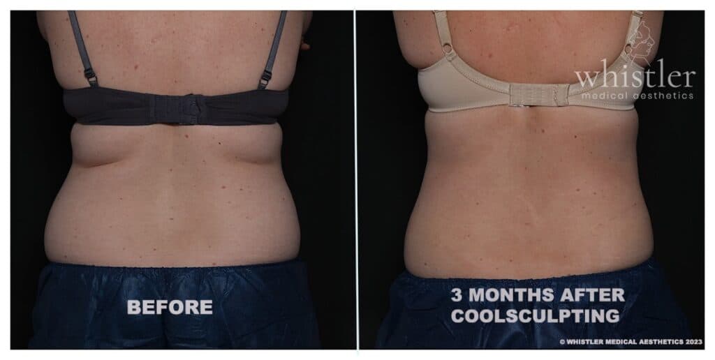 COOLSCULPTING-BRA-FAT-2023-1024x516