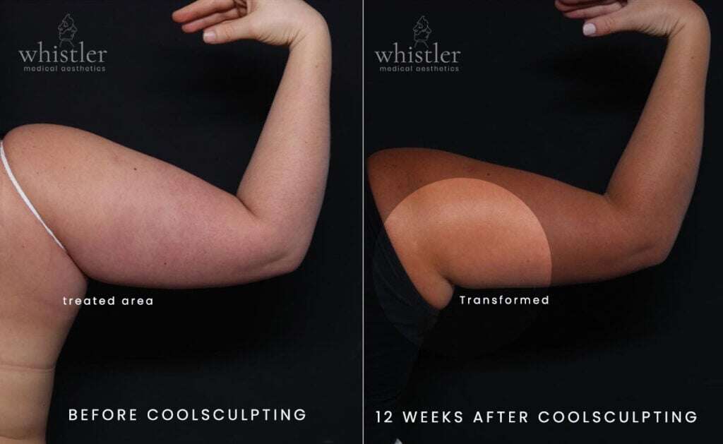 CS-ARMS-BEFORE-AFTER-BRANDED-1024x629