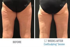 CS-Thighs-before-after-300x203