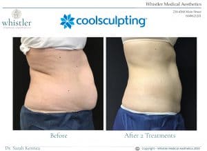 Coolscupting-L-W-before-and-After-300x219
