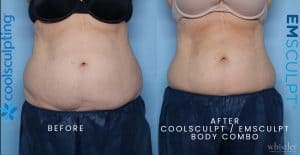 FEMALE-BODY-CS-EM-COMBO-FRONT-300x155