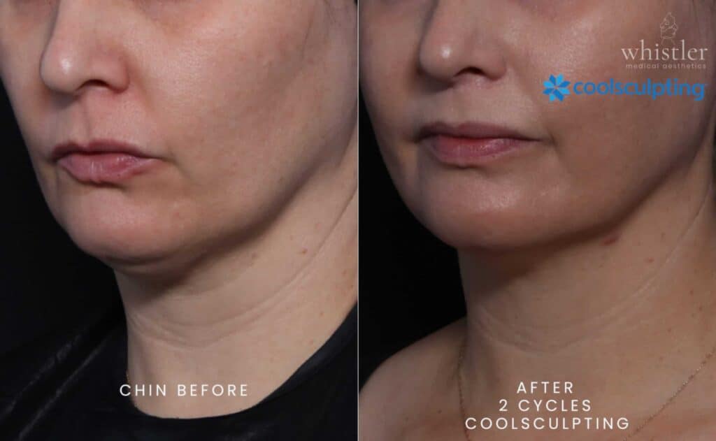FEMALE-CHIN-2-CYCLES-CS-scaled-e1663702736657-1024x631