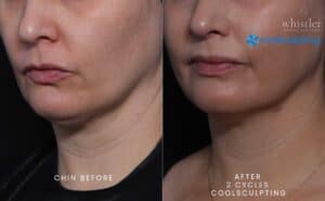 FEMALE-CHIN-2-CYCLES-CS-scaled-e1663702736657-300x185