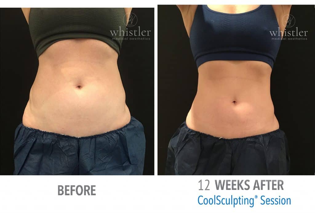 Femal-abdomen-flanks-web-before-after-1024x691