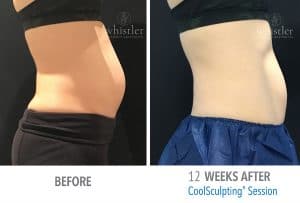 Femal-right-web-before-after-300x203