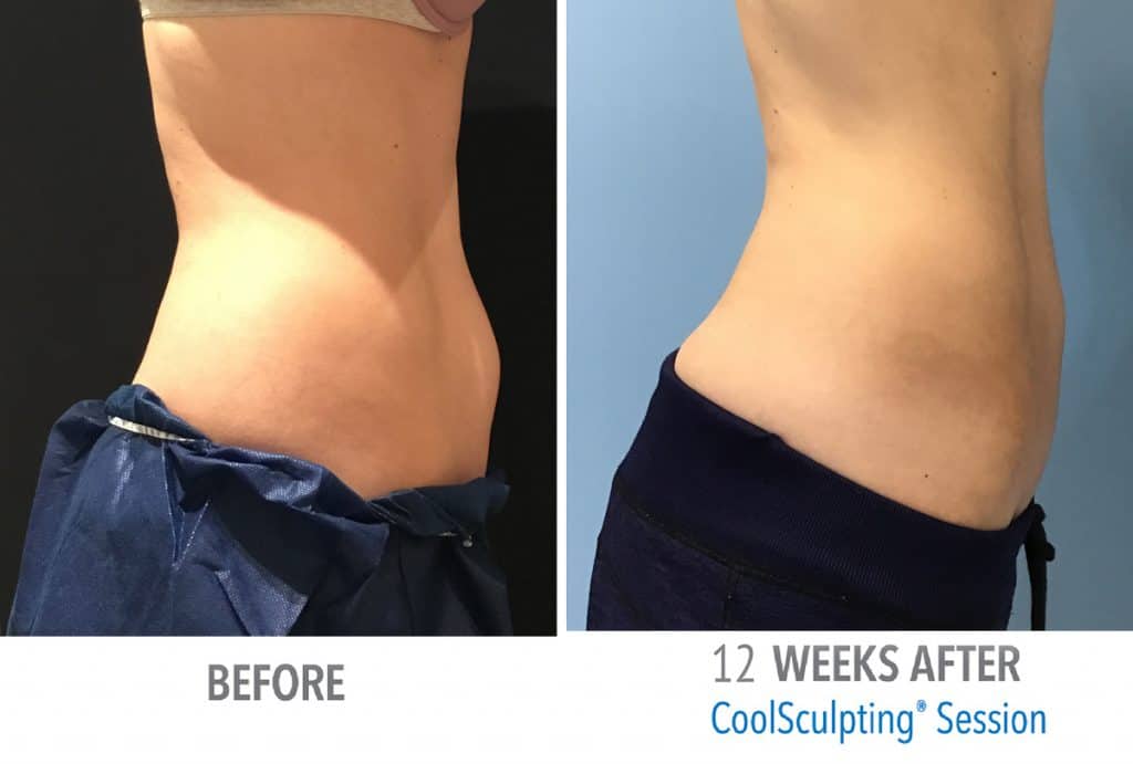 Femal-slim-web-before-after-1024x691