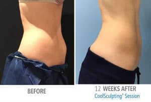 Femal-slim-web-before-after-300x203