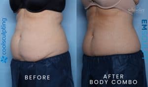 Female-Abdomen-body-combo-CS-Emsculpt-Jan-2022-300x176