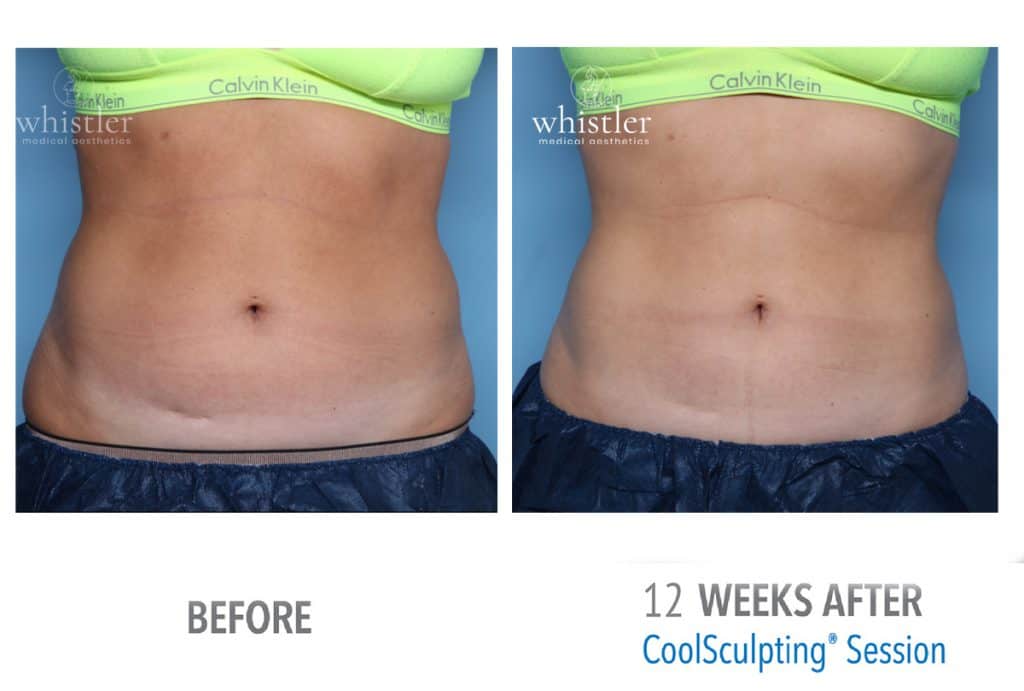 Female-front-view-abdominal-coolsculpting-1024x691