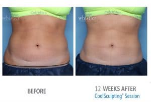 Female-front-view-abdominal-coolsculpting-300x203