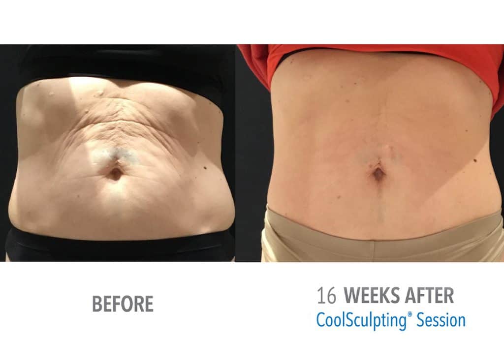 Female-improved-skin-tone-web-before-after-copy-1024x691