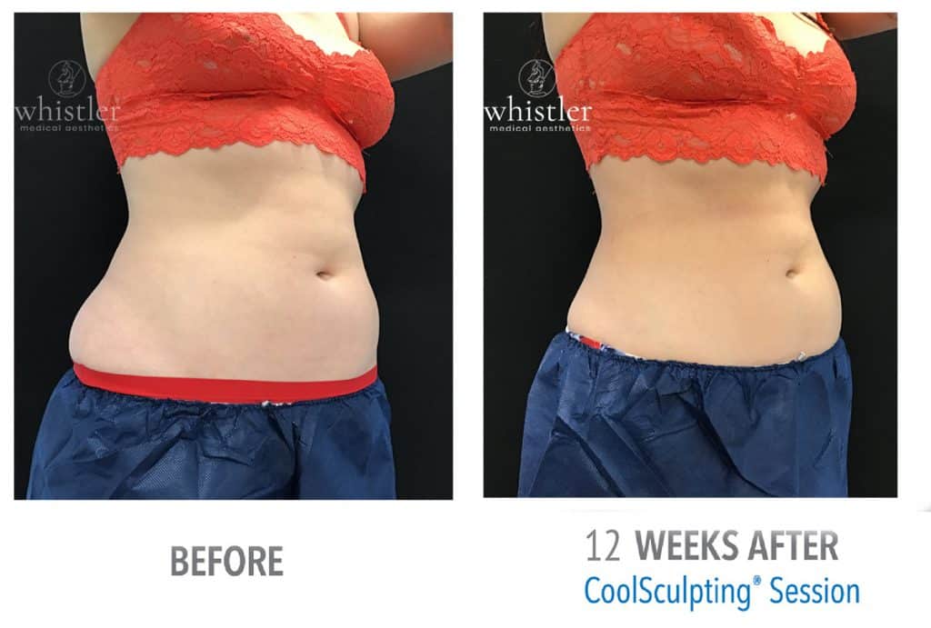 Female-side-45-abdominal-fat-reduction-1024x691