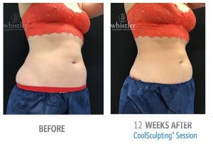 Female-side-45-abdominal-fat-reduction-300x203